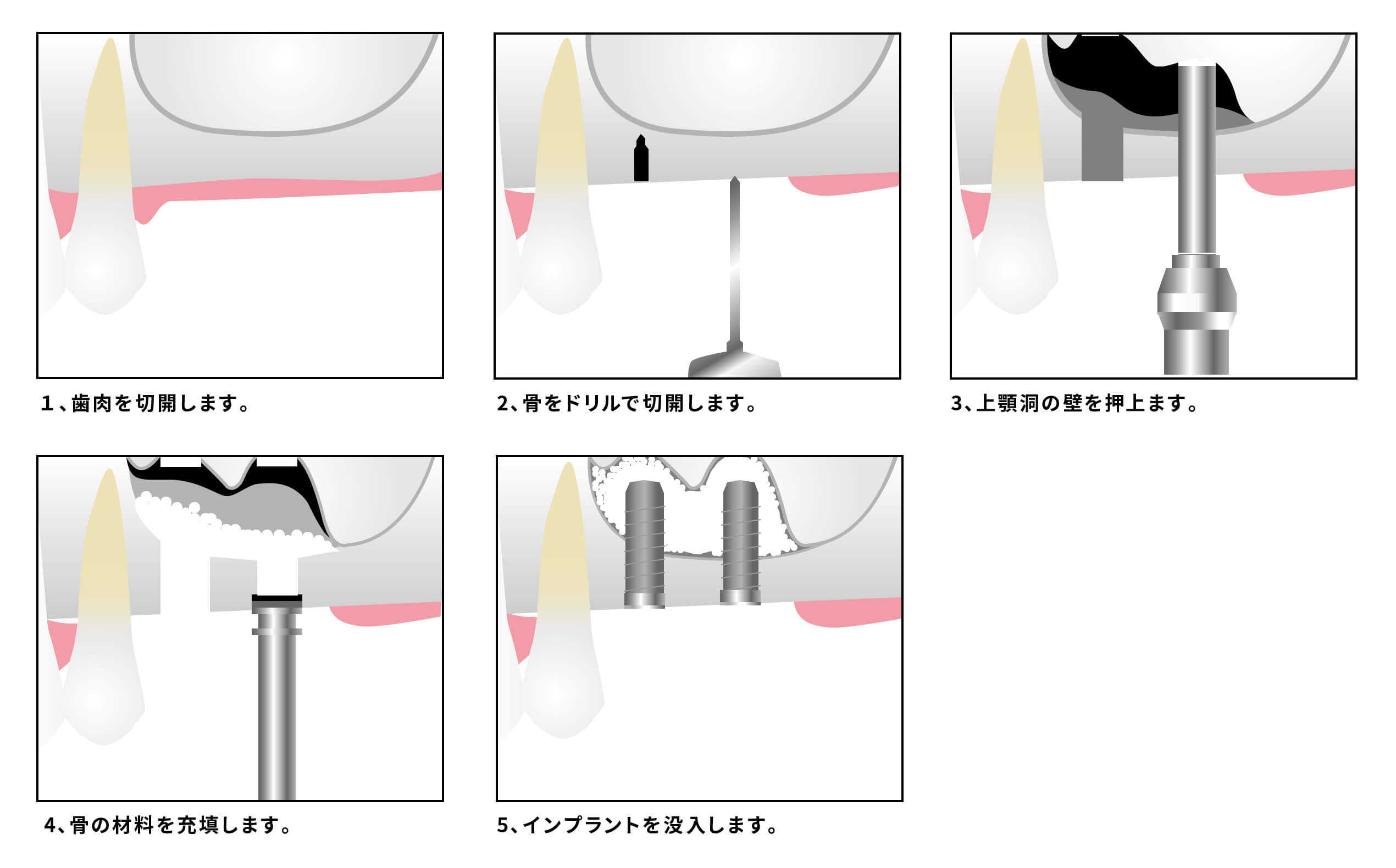 ソケットリフトの流れ