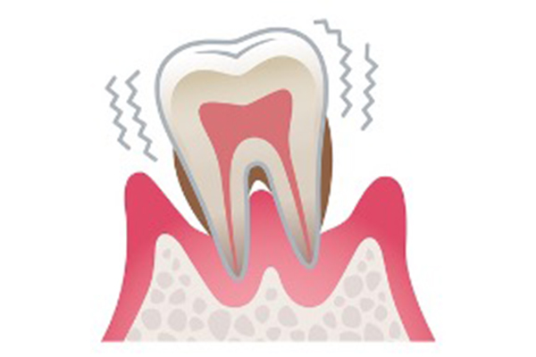 歯の動揺度