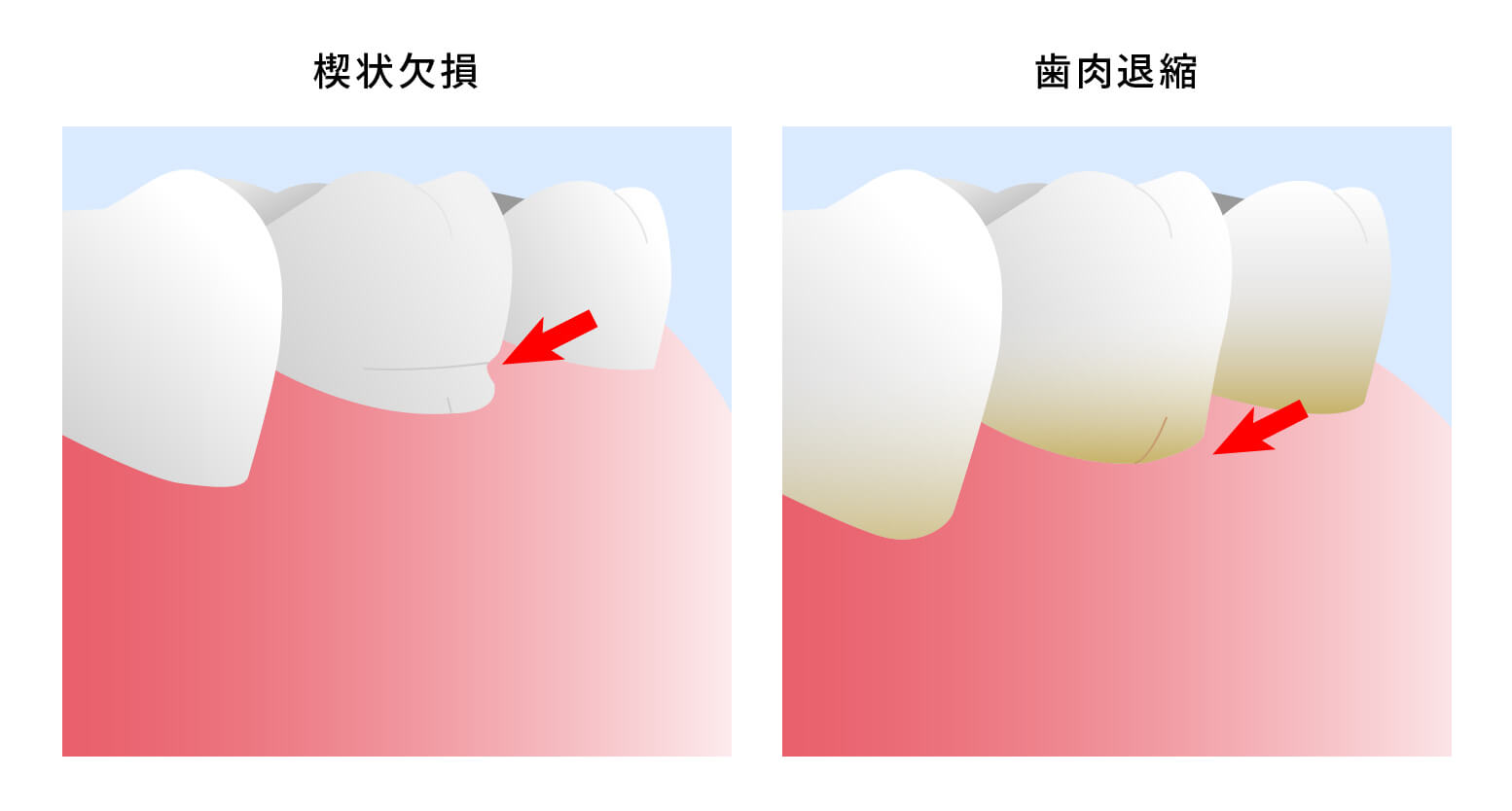 象牙質の露出